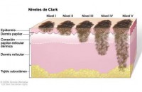 mexico melanoma
