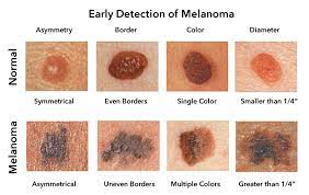 ¿Cómo se diagnostica el melanoma