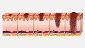 ¿Cuáles son las etapas del melanoma y qué significan